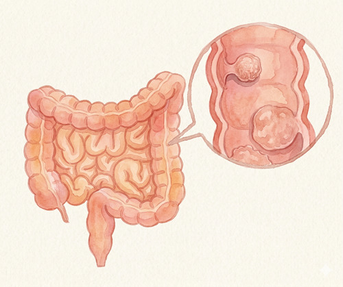 大腸ポリープ切除